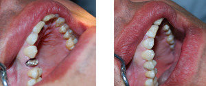 Comment installer la couronne sur la dent