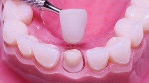 Installation de couronnes sur les dents