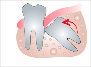 La croissance des dents de sagesse peut entraîner de graves problèmes de morsure