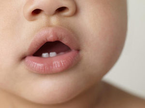 Les symptômes de la dentition chez les bébés