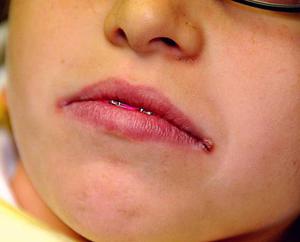 Pourquoi les pustules apparaissent