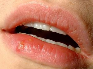 Causes des plaies sur les lèvres