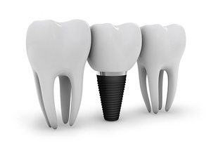 En quel matériau sont fabriqués les implants?