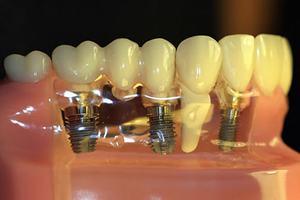 Les meilleurs prothèses et implants