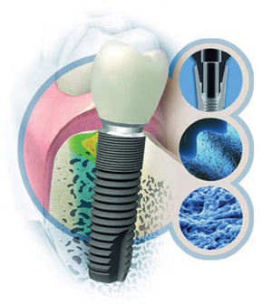 Fabrication d'implants dentaires