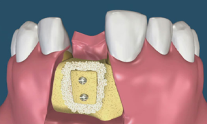 Examens de l'accumulation osseuse au cours des implants dentaires