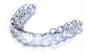 Le bouchon en silicone est fabriqué individuellement pour chaque patient. Elle est mise avant d'aller se coucher. Capa conserve l'émail des dents lorsqu'il est frotté