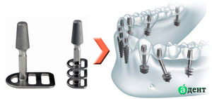 Coût d'implantation basale Indications pour l'implantation basale