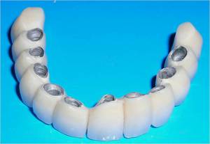 Couronnes installées sur des implants