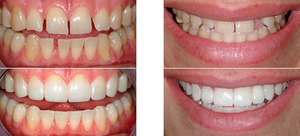 La restauration des dents est très nécessaire dans de nombreux cas.