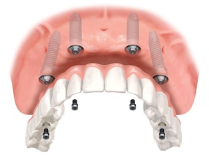 Dentier