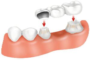 Les dents prothétiques peuvent être très différentes.