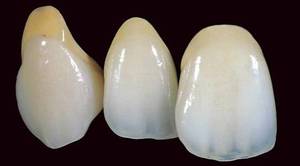 Les couronnes en métal-céramique ressemblent à des dents naturelles.