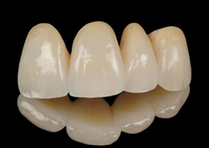 Les couronnes en céramique ressemblent beaucoup aux dents naturelles.