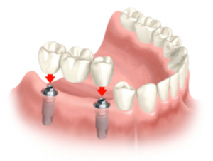 Ponts - il s'agit d'une solution courante en dentisterie.