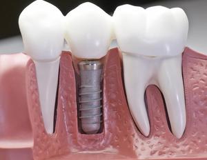 Les implants dentaires ressemblent le plus à de vraies dents et sont très pratiques, ne gênent pas les autres dents et ne les ferment pas.