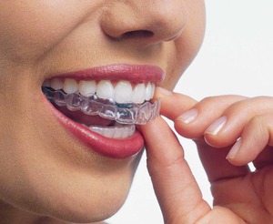 Aligner la morsure