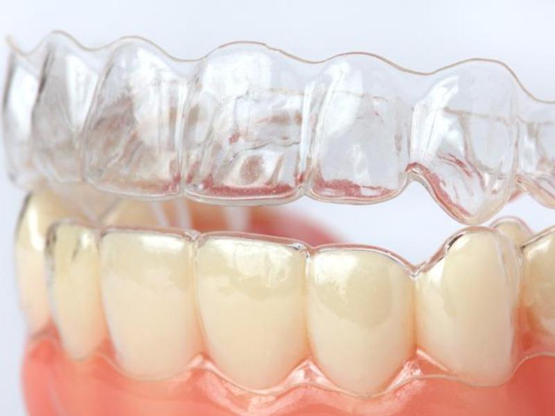 Correction de morsure sans accolades Plaque pour les dents