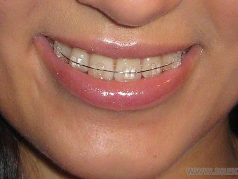 Bretelles en saphir dans la bouche