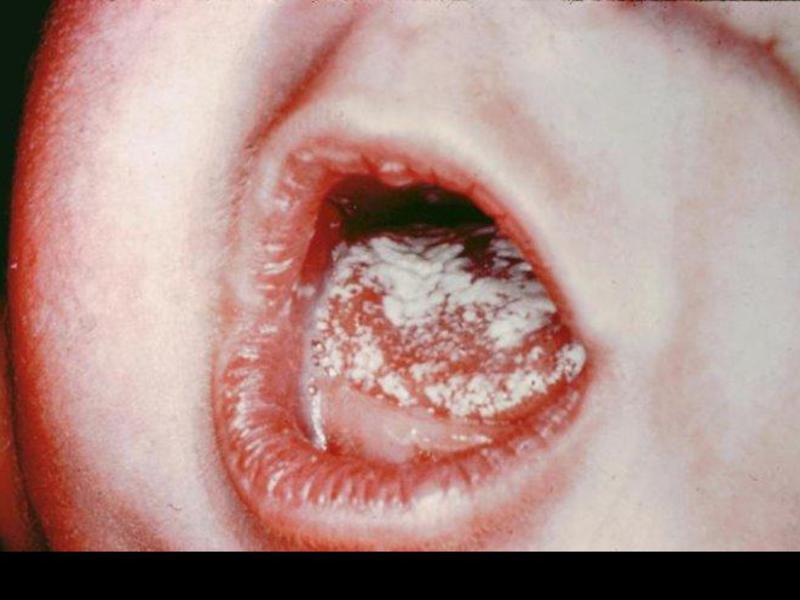 Comment aider votre bébé avec le muguet