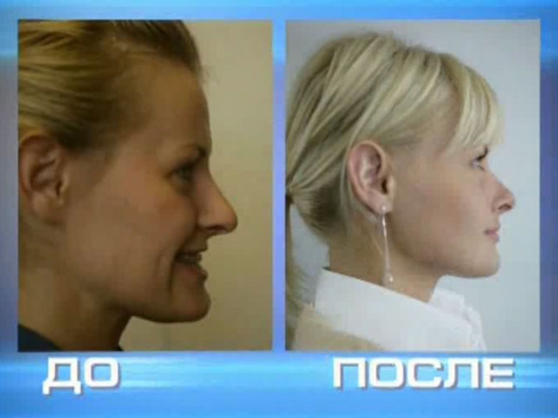 Causes de malocclusion