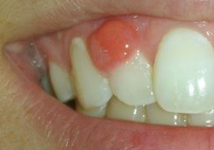 Causes de flux