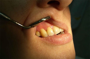 Photo de périostite odontogène